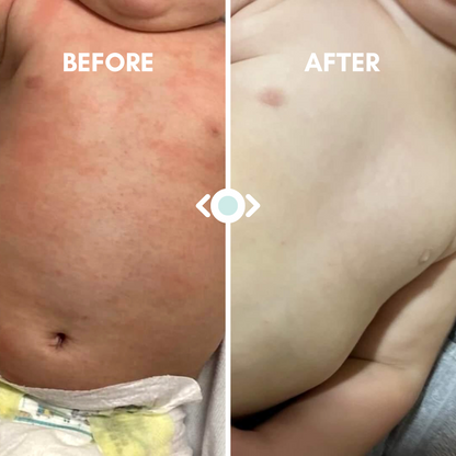 Baby Eczema Relief Bundle
